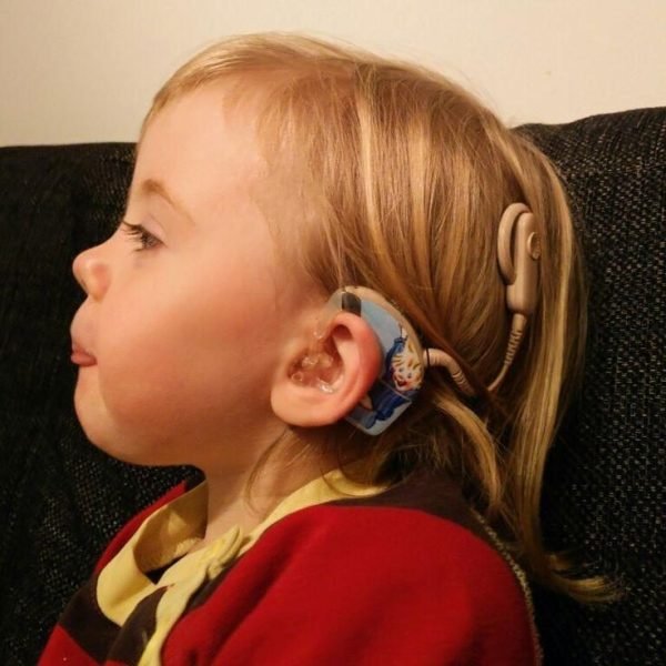 What is cochlear implant and how it works? - DP-HO