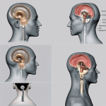 How has cochlear implant technology advanced in recent years and how can it help someone who is profoundly or severely deaf?