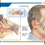 A detailed anatomical diagram illustrating an Adult Cochlear Implant and how it functions. The image shows a side profile of an adult head with the device components labeled, including the external speech processor, microphone, battery, transmitting coil, internal receiver/stimulator, and the electrode array inserted into the cochlea. A magnified inset view depicts sound waves entering the ear. The top left corner features the 'Special Ed Expert Ali' logo, and the bottom right corner features the 'DPHO Disable Persons Health Organization' logo